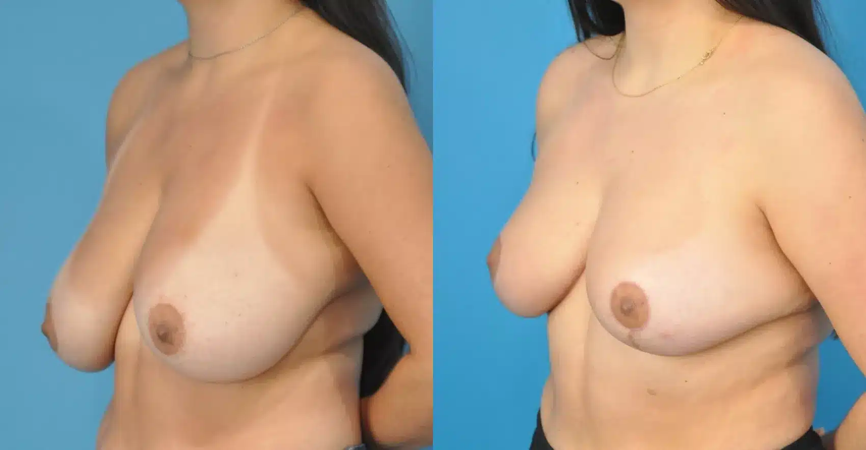 Before and After Image: Case #167 - left-front-oblique