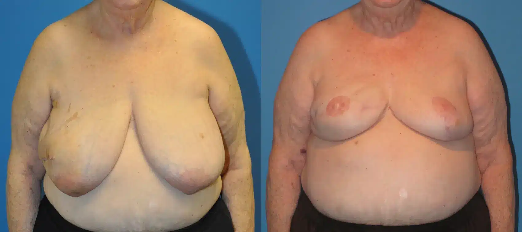 Before and After Image: Case #17 - front