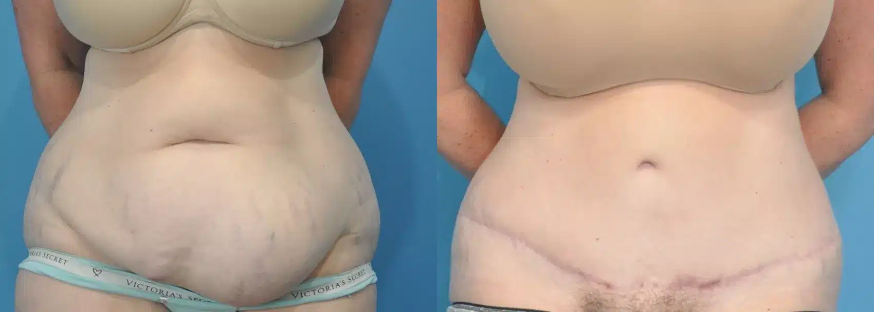 Before and After Image: Case #170 - front