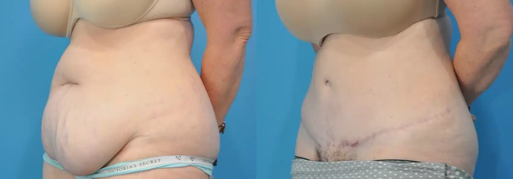 Before and After Image: Case #170 - left-front-oblique