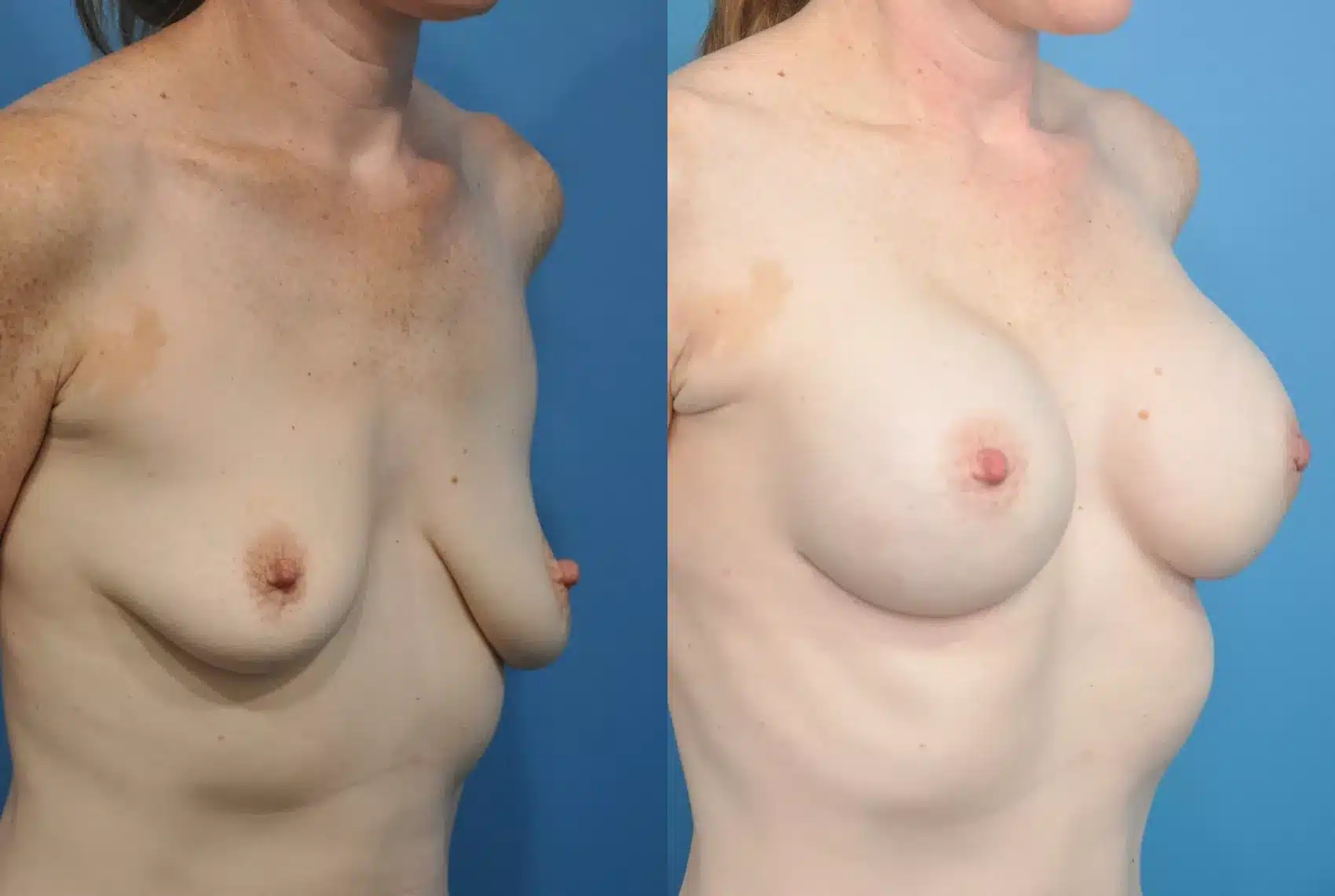 Before and After Image: Case #171 - right-front-oblique