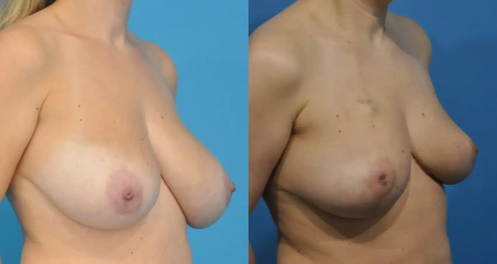 Before and After Image: Oncoplastic Reduction and Lift for Breast Cancer - right-front-oblique