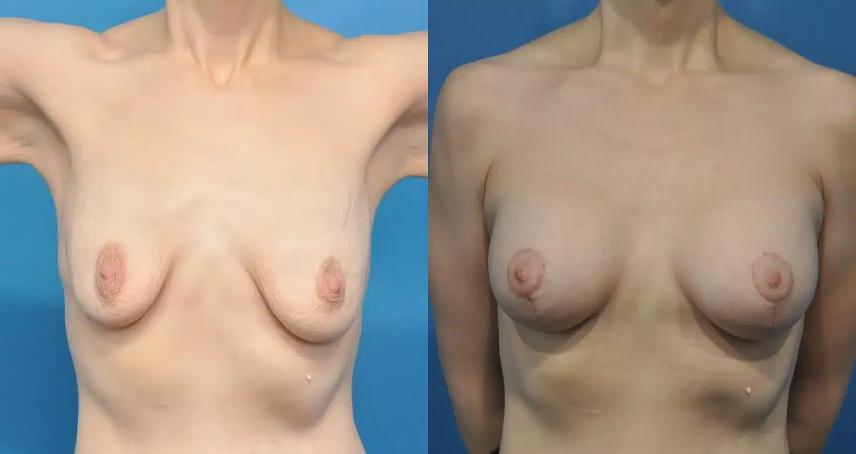 Before and After Image: Case #173 - front