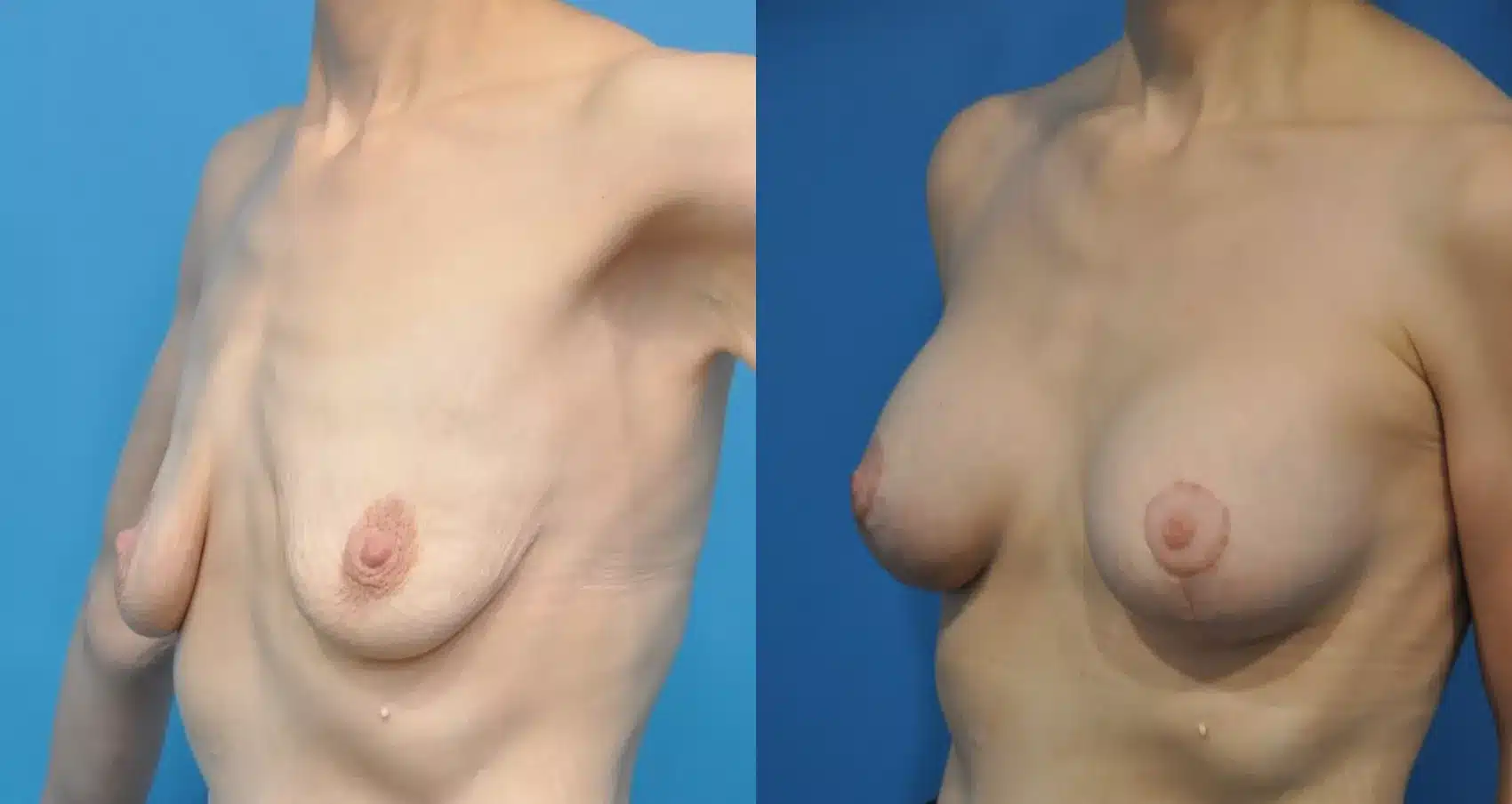 Before and After Image: Case #173 - left-front-oblique