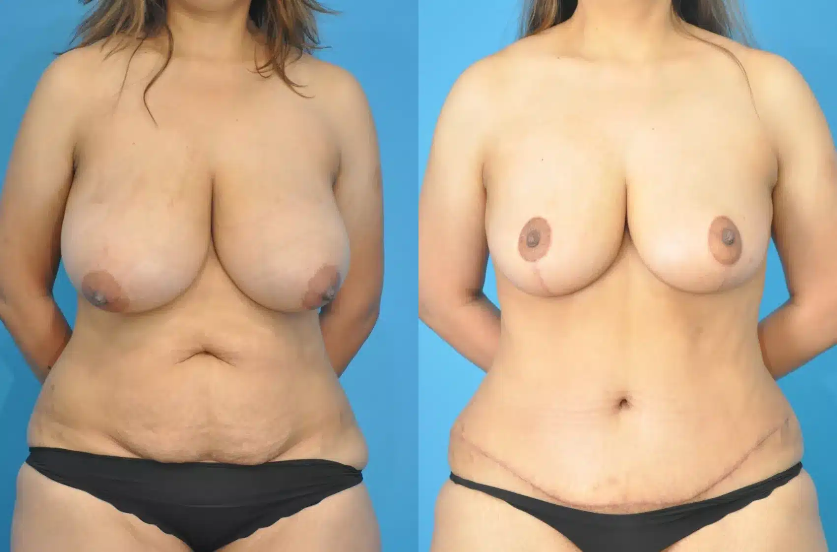 Before and After Image: Case #174 - front
