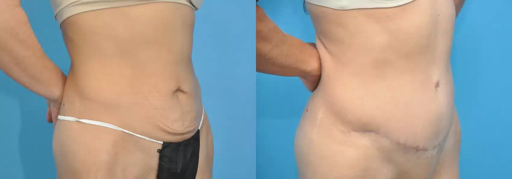 Before and After Image: Case #176 - right-front-oblique