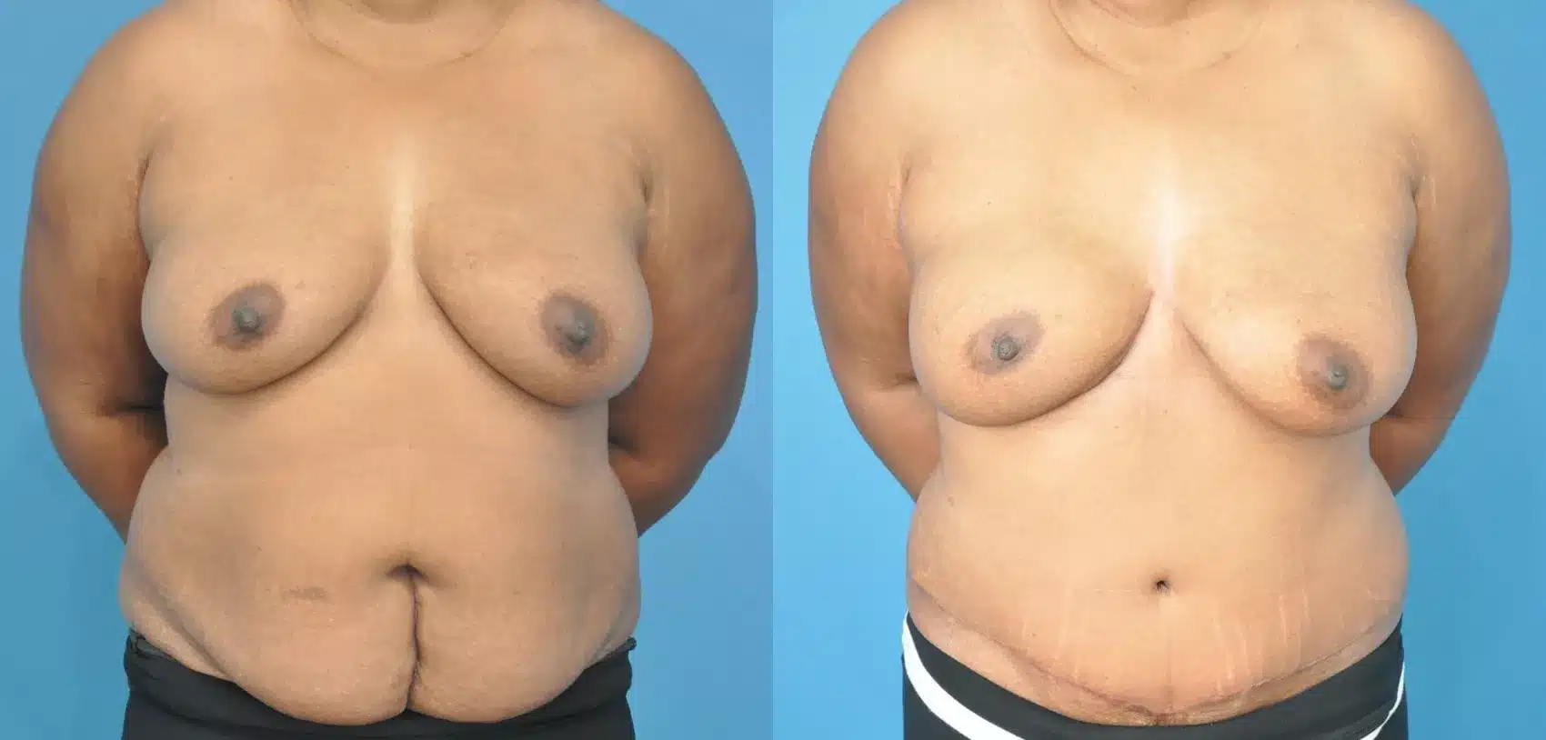 Before and After Image: Case #177 - front