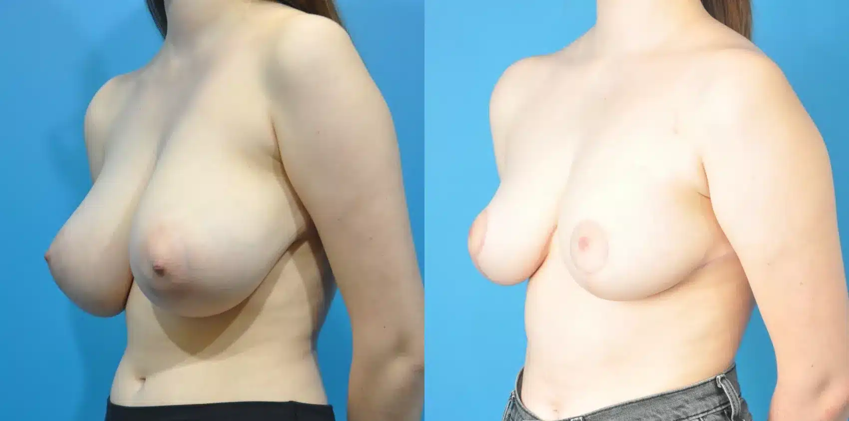 Before and After Image: Case #178 - left-front-oblique