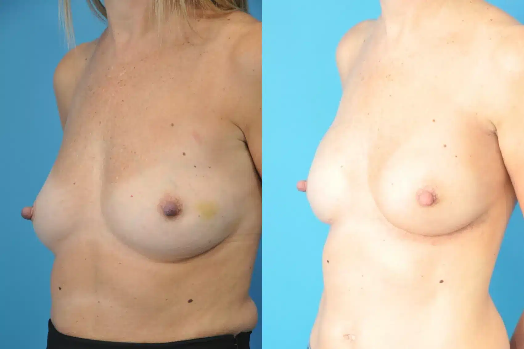 Before and After Image: Case #180 - left-front-oblique