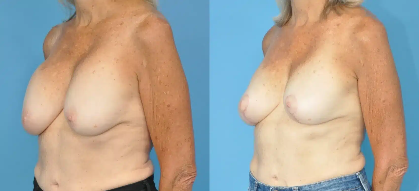 Before and After Image: Revision Breast Augmentation with Lift - left-front-oblique