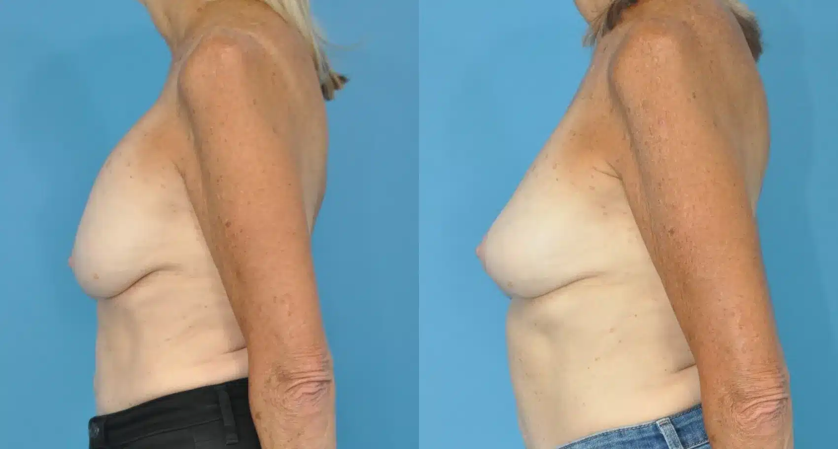 Before and After Image: Revision Breast Augmentation with Lift - left-side