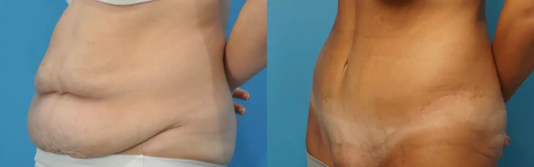 Before and After Image: Case #182 - left-front-oblique