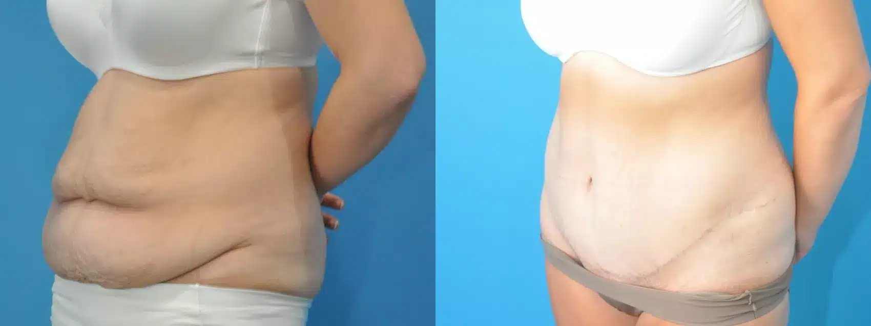 Before and After Image: Case #182 - left-front-oblique
