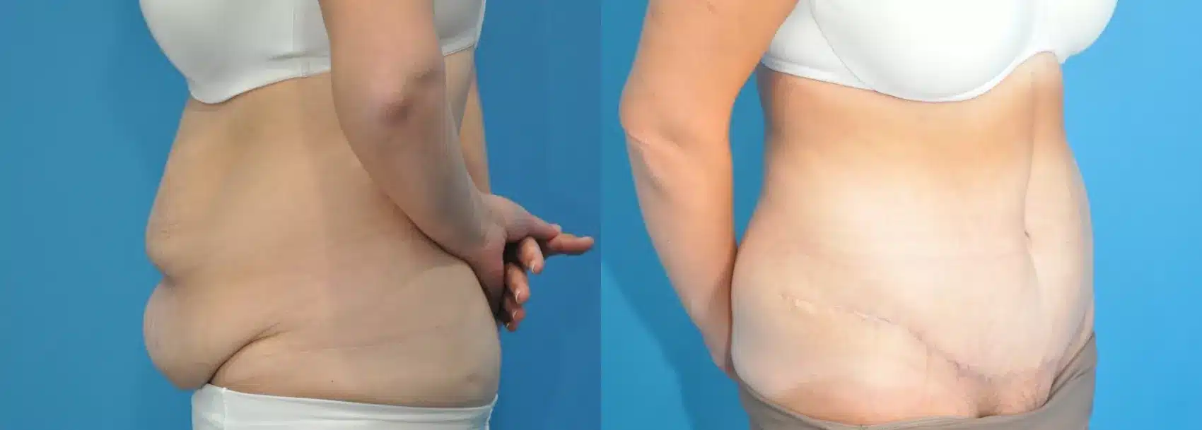 Before and After Image: Case #182 - front