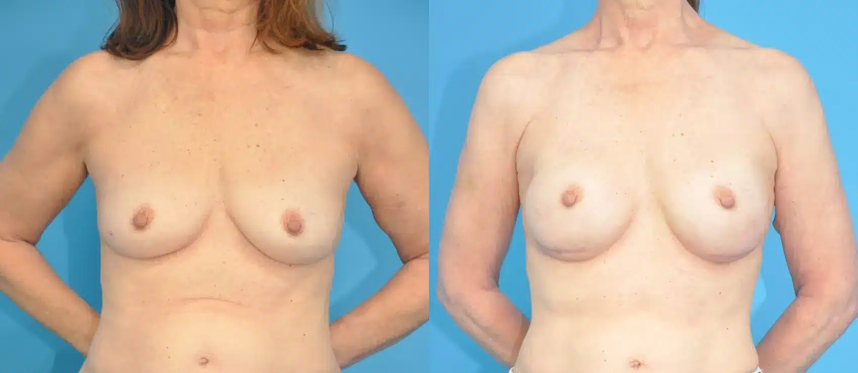 Before and After Image: Case #183 - front