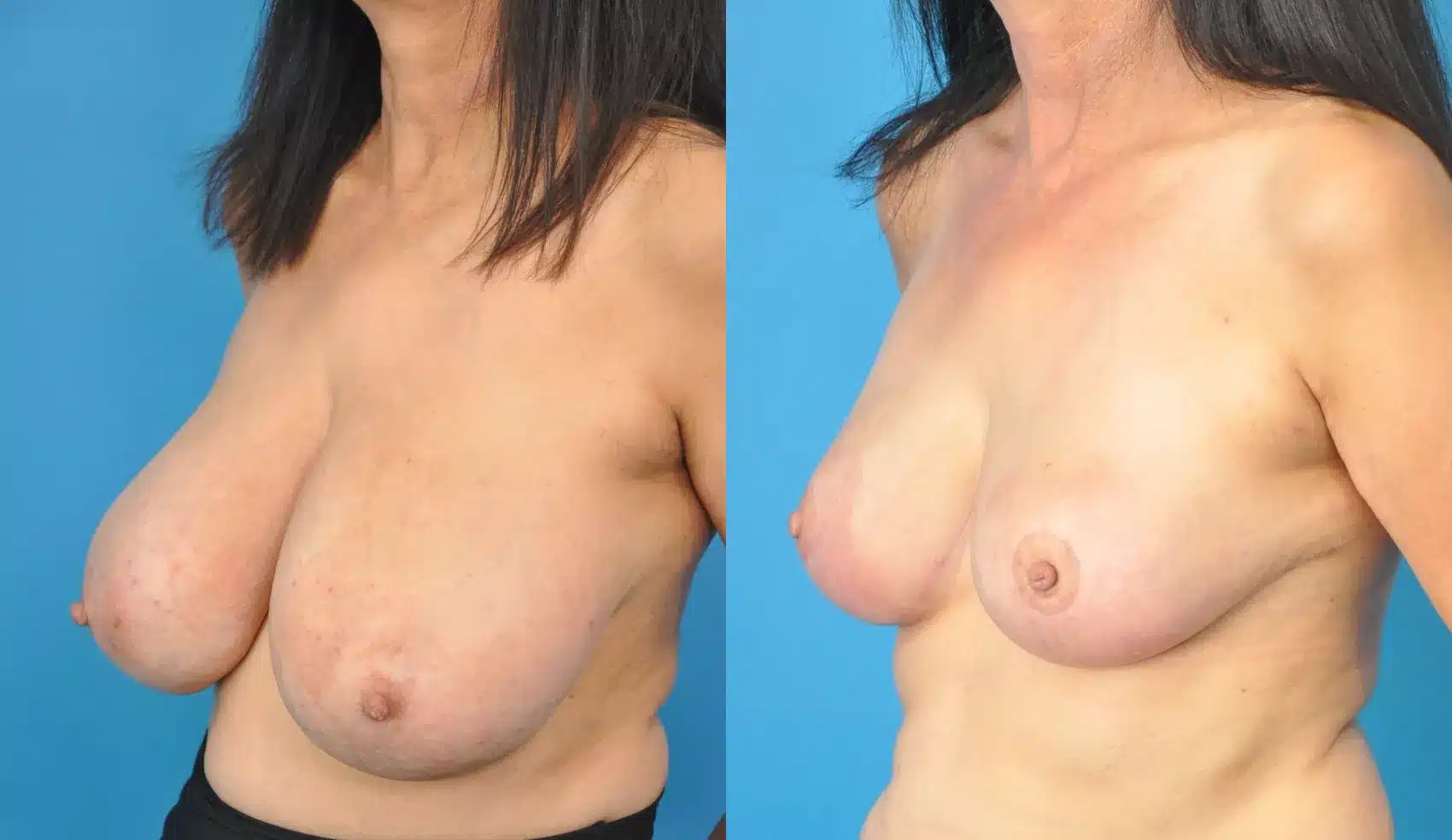 Before and After Image: Case #184 - left-front-oblique