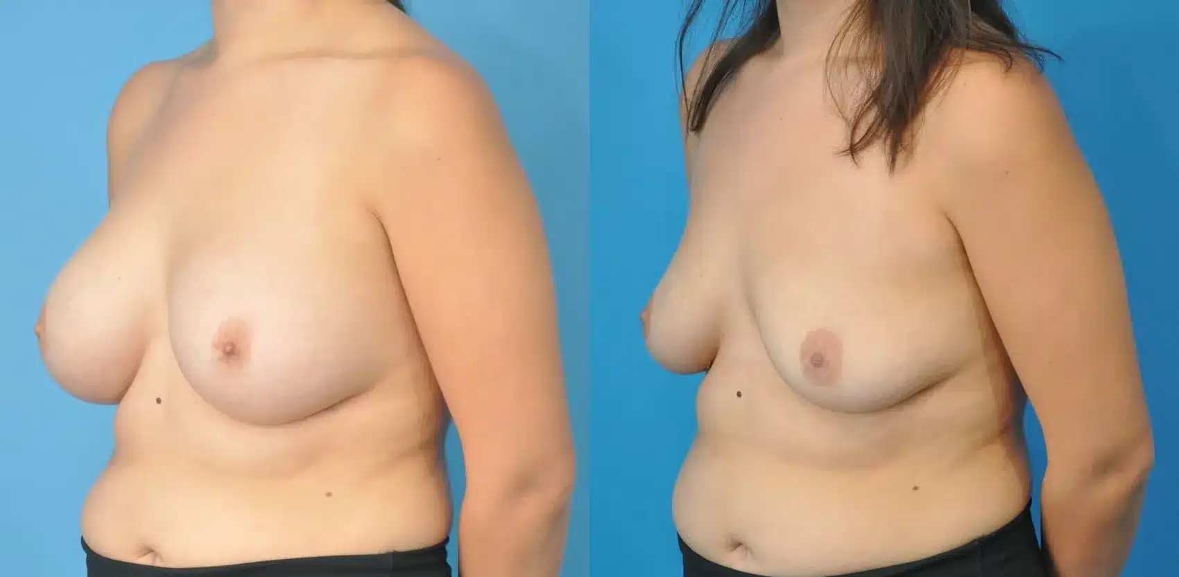 Before and After Image: Awake Breast Implant Removal - left-front-oblique