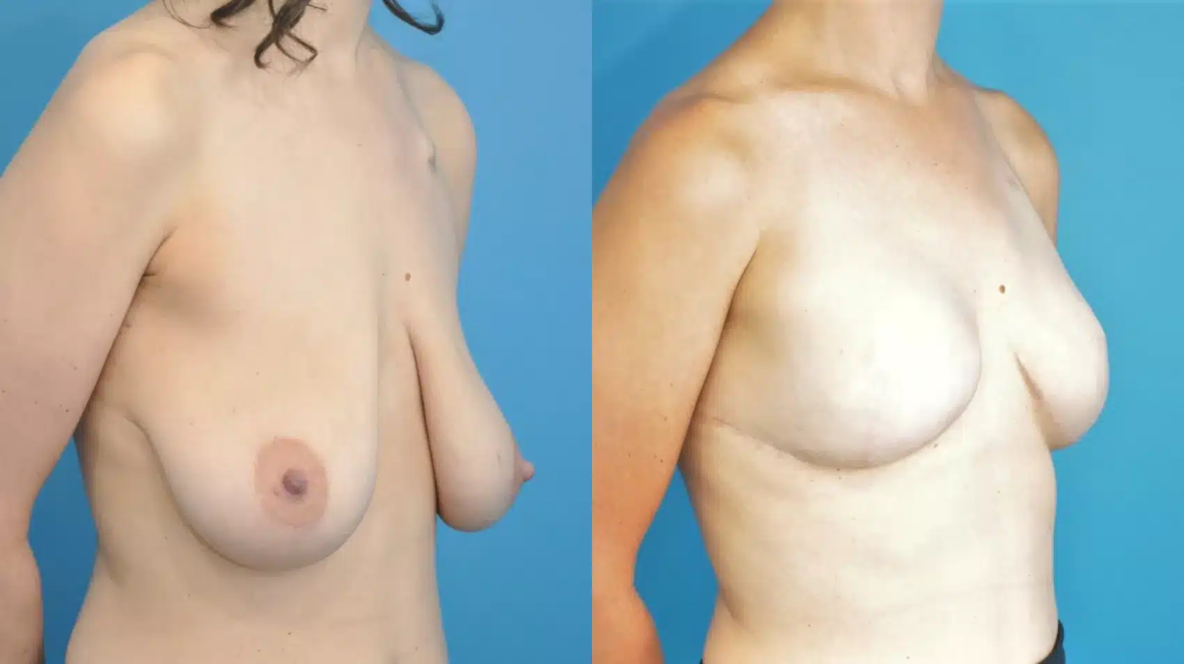 Before and After Image: Case #186 - right-front-oblique