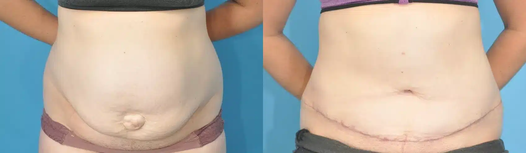 Before and After Image: Case #189 - front