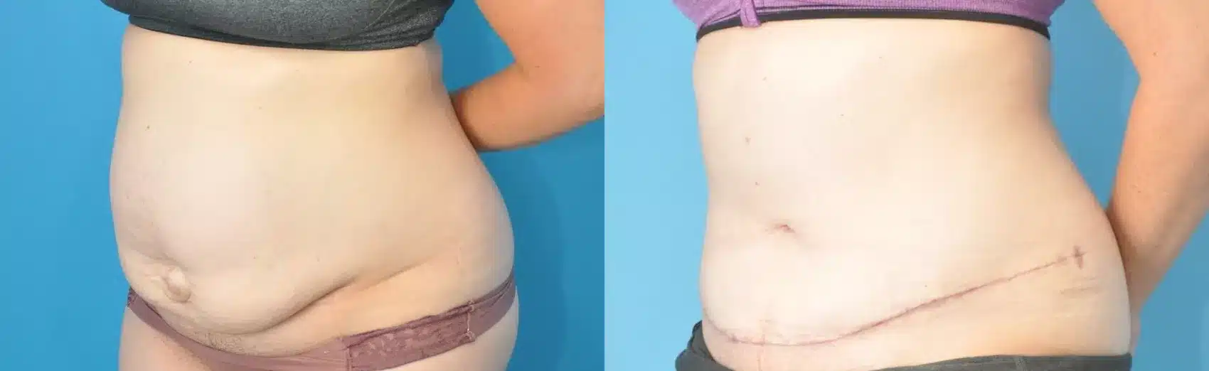 Before and After Image: Case #189 - left-front-oblique