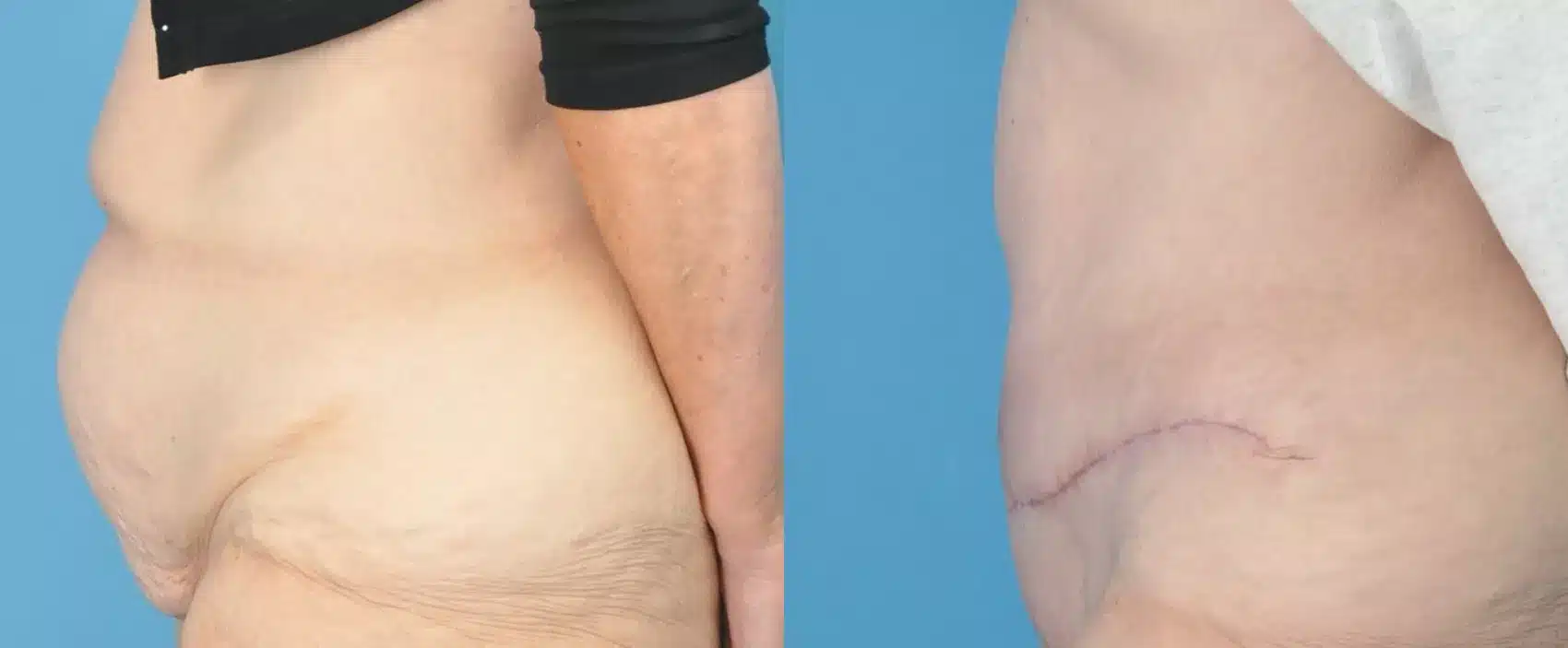 Before and After Image: Case #190 - left-side