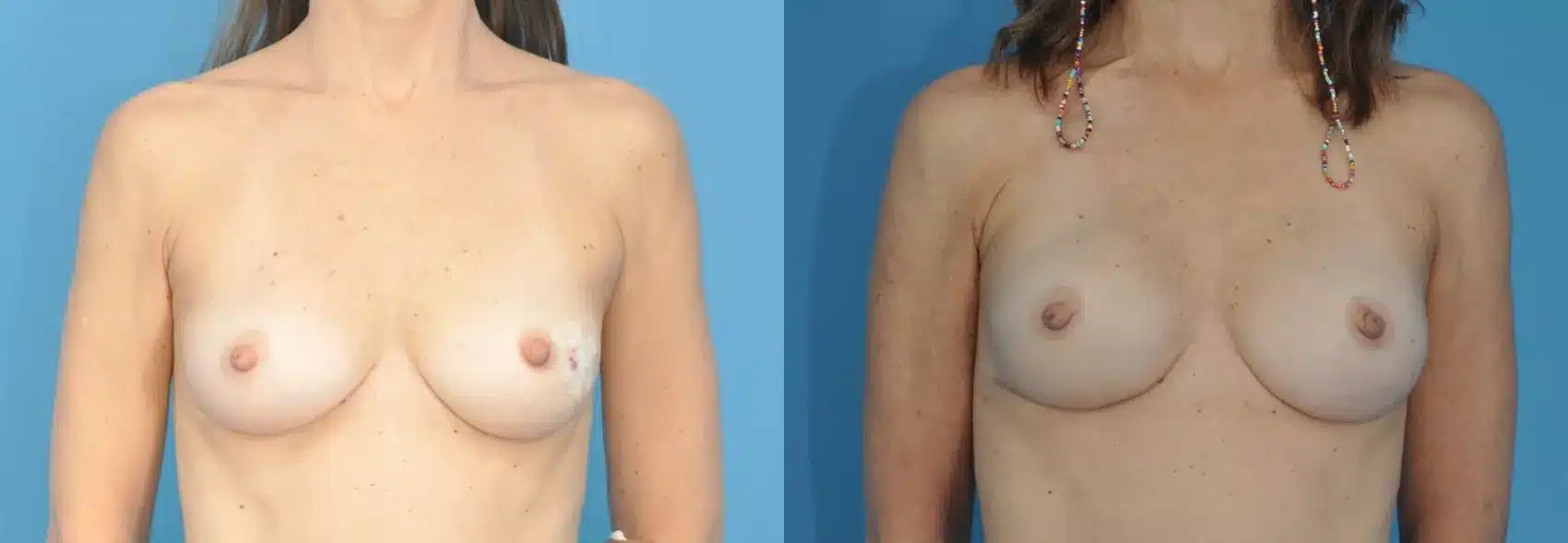 Before and After Image: Case #191 - front