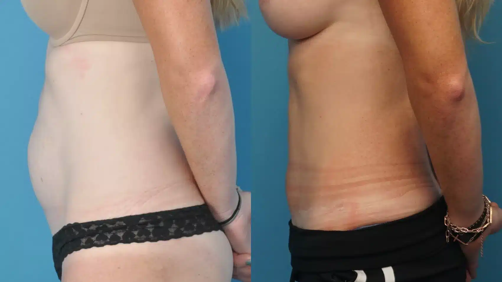 Before and After Image: Case #192 - left-side