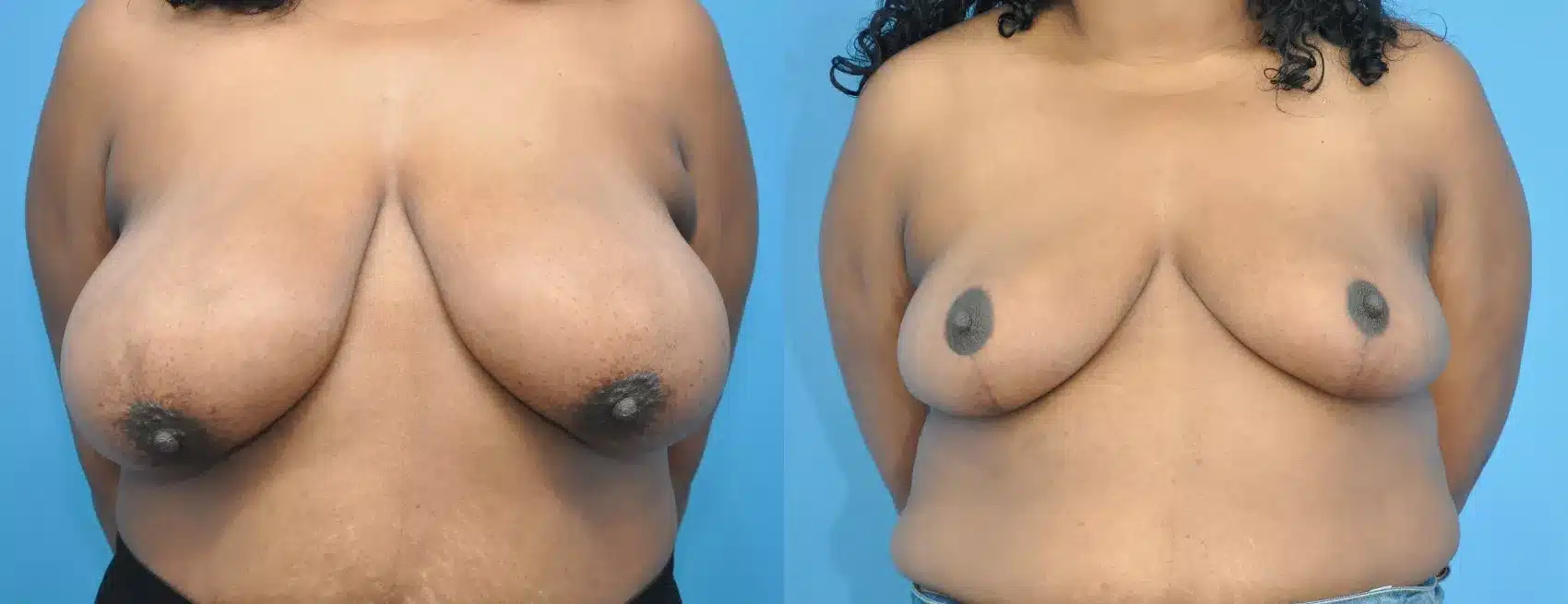 Before and After Image: Case #193 - front