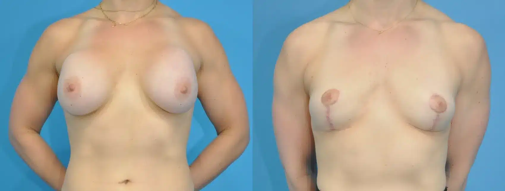 Before and After Image: Breast Implant Removal with Lift - front