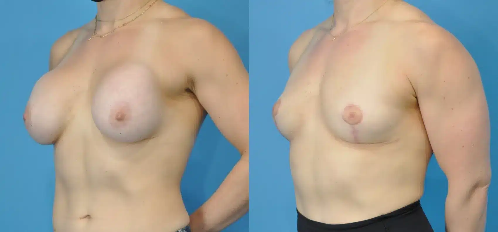 Before and After Image: Breast Implant Removal with Lift - left-front-oblique