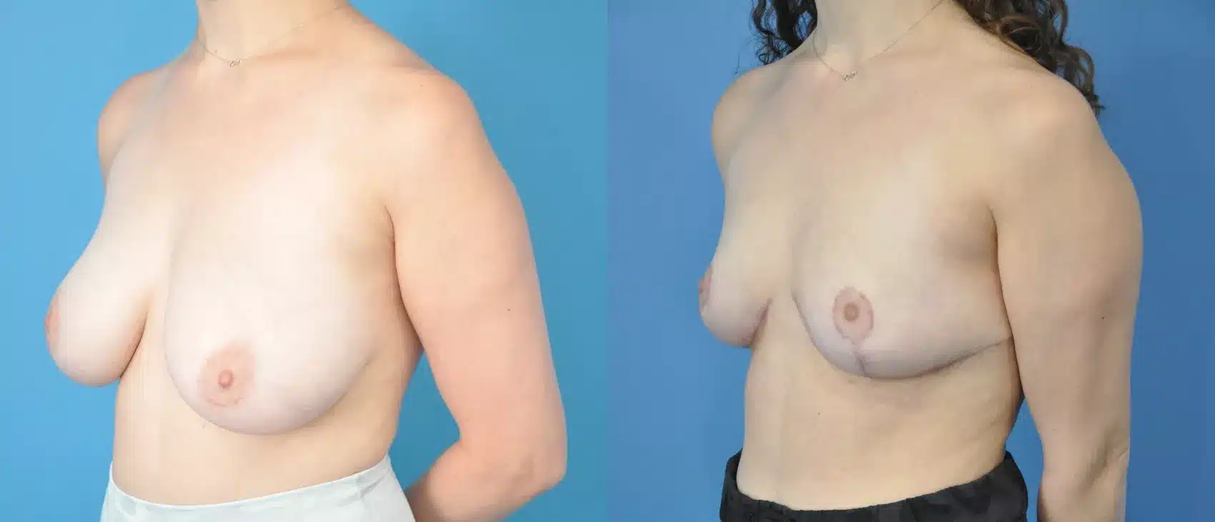 Before and After Image: Case #197 - left-front-oblique