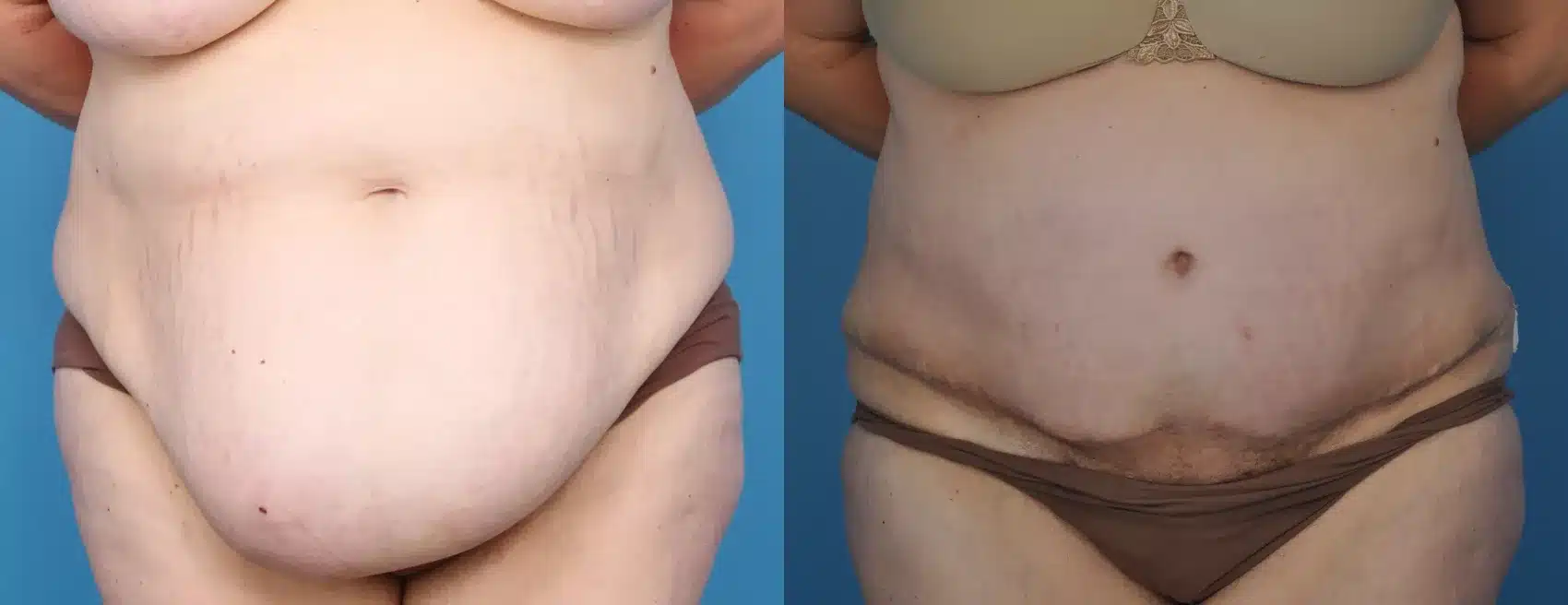 Before and After Image: Case #20 - front