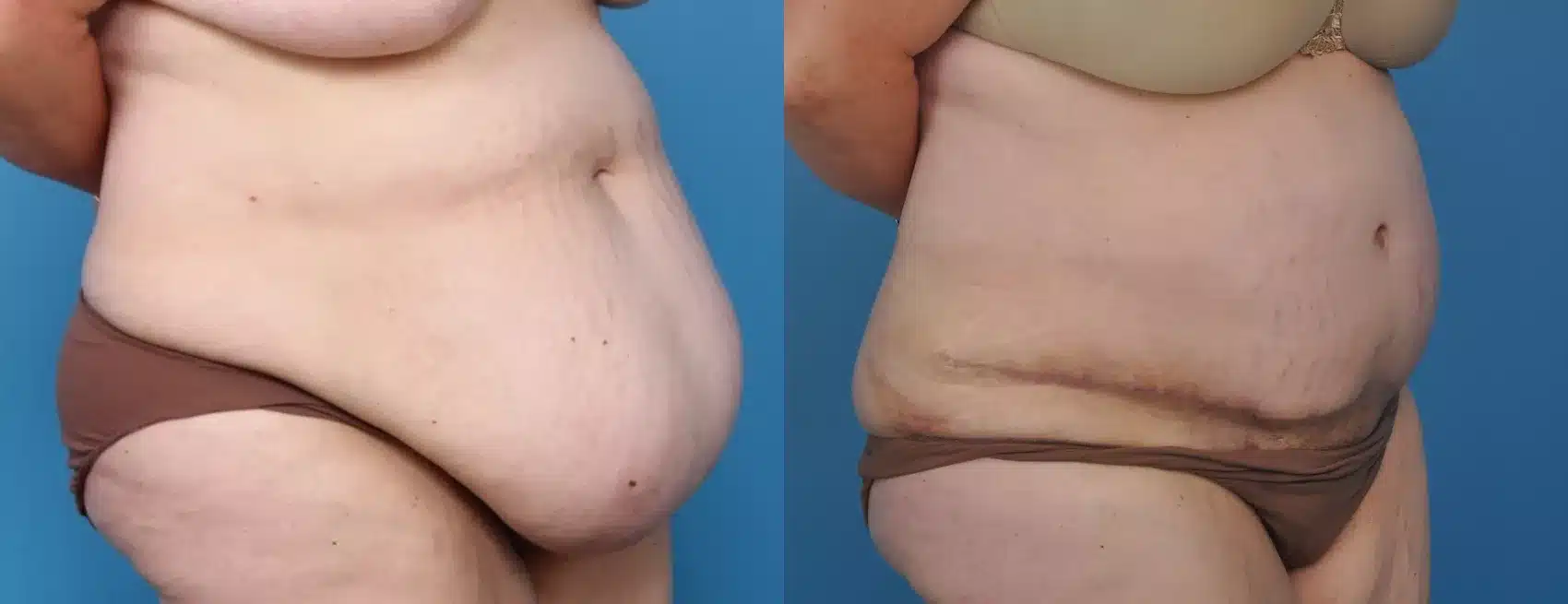 Before and After Image: Case #20 - right-front-oblique