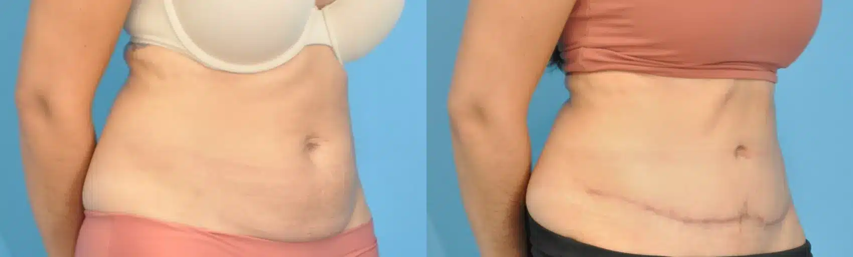 Before and After Image: Case #200 - right-front-oblique
