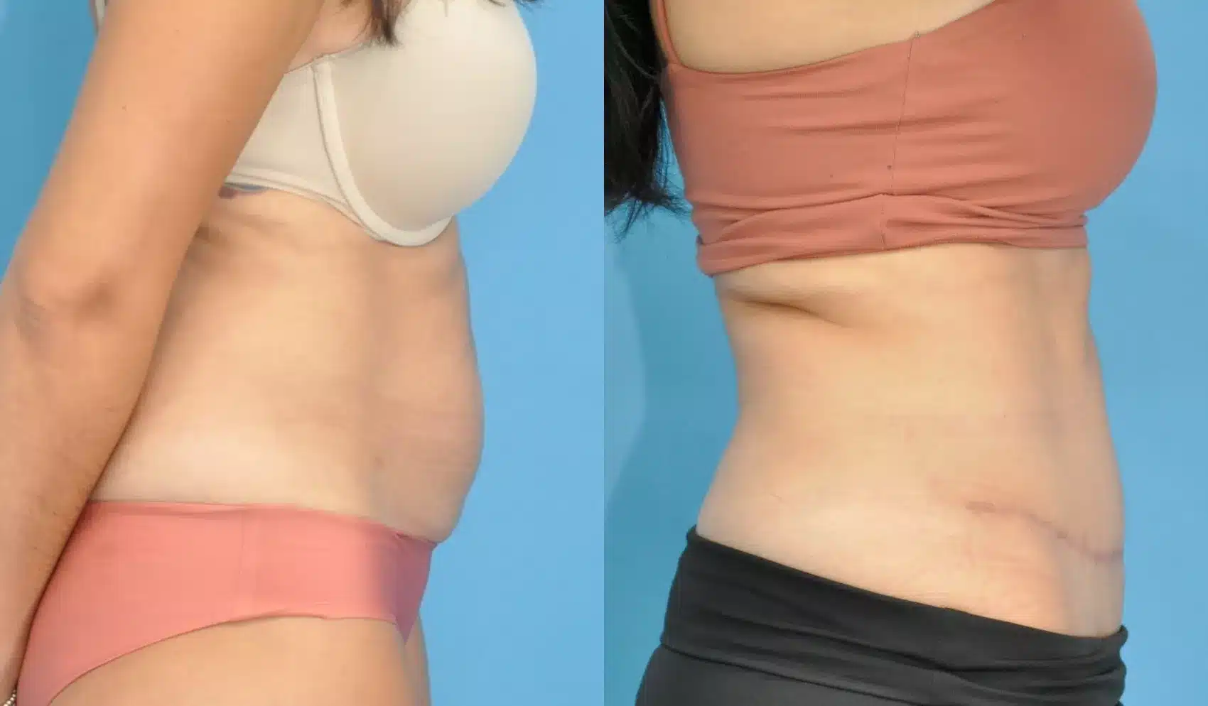 Before and After Image: Case #200 - right-side