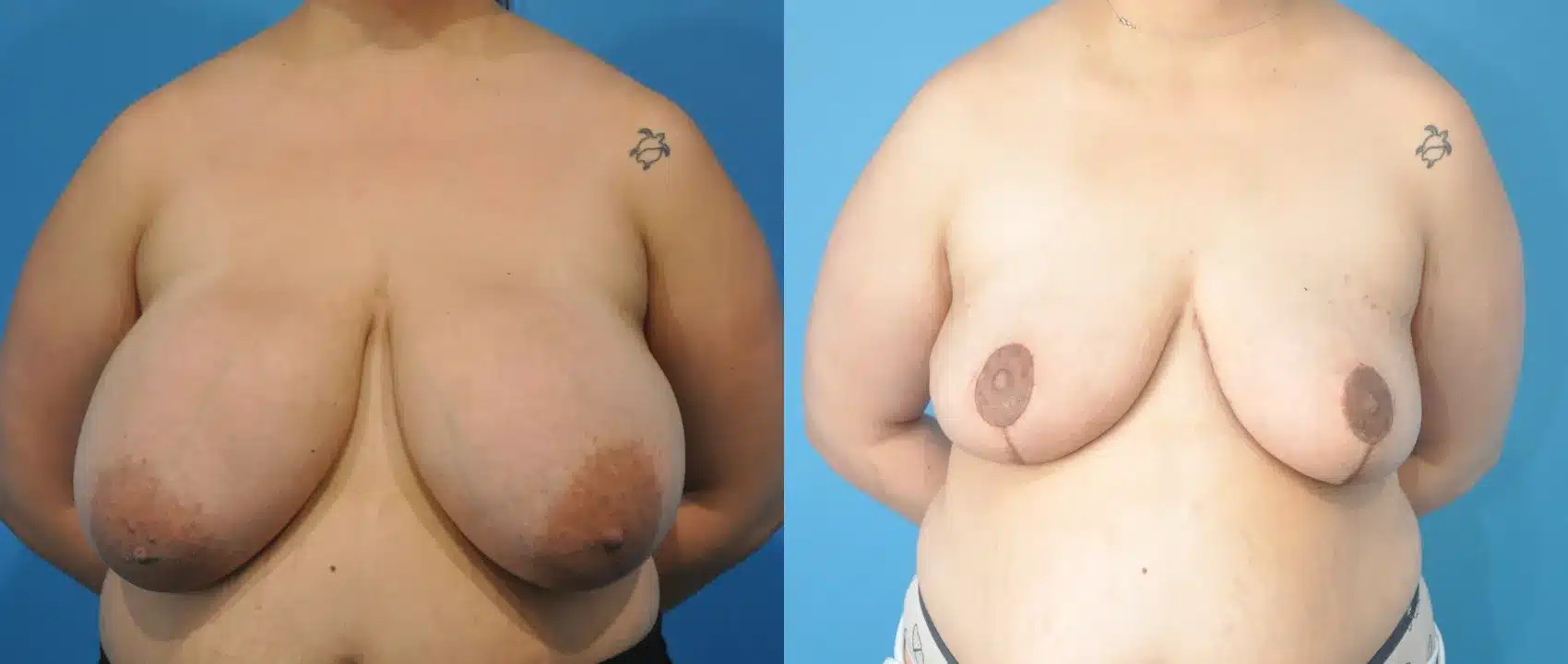 Before and After Image: Breast Reduction and lift - front