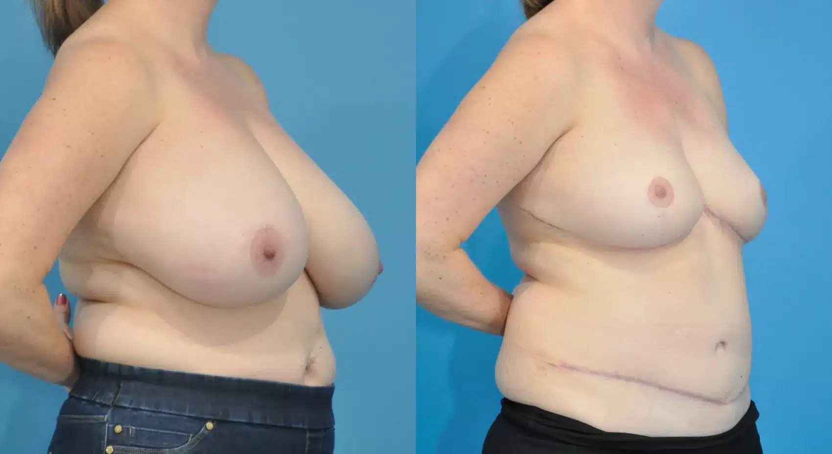 Before and After Image: Case #206 - right-front-oblique