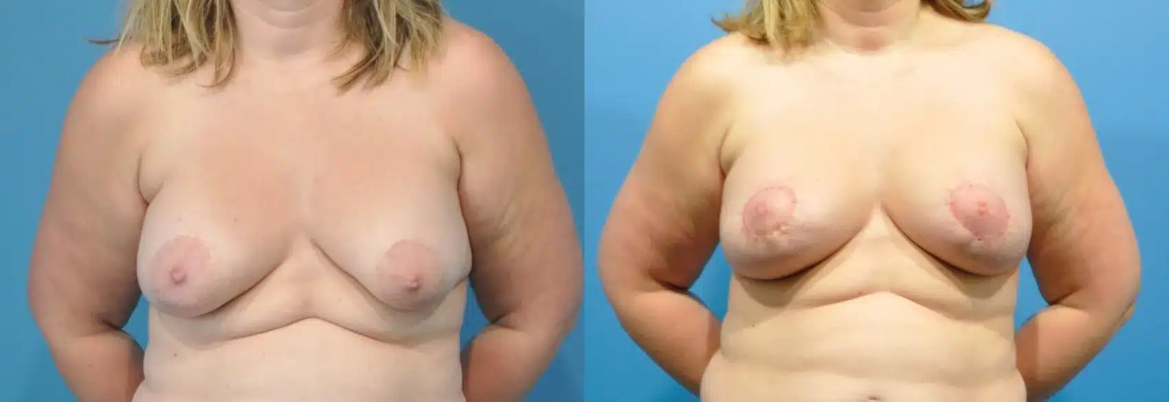 Before and After Image: Case #207 - front