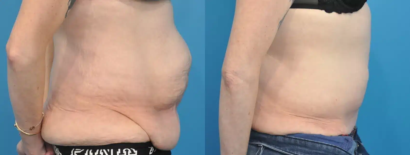 Before and After Image: Case #209 - right-side