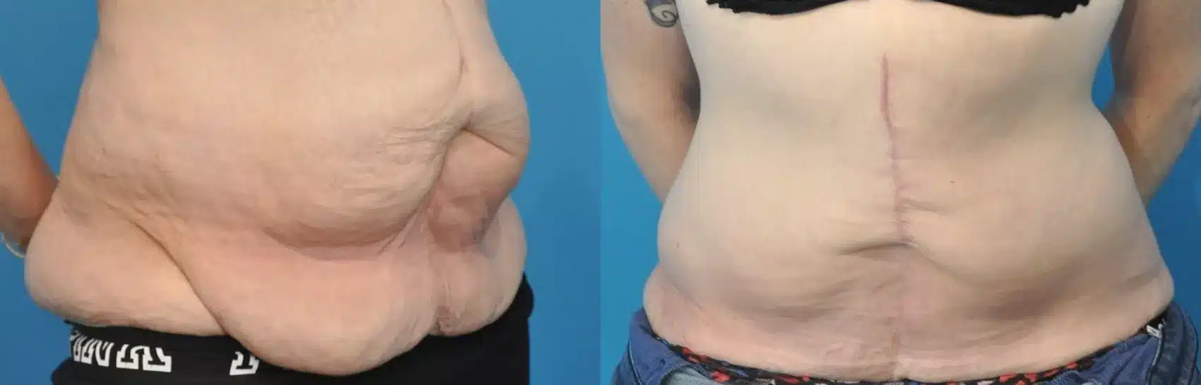 Before and After Image: Case #209 - front