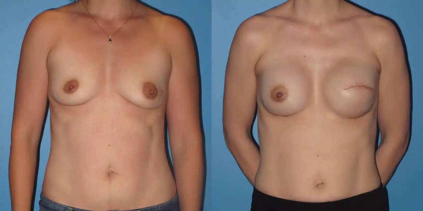 Before and After Image: Case #21 - front