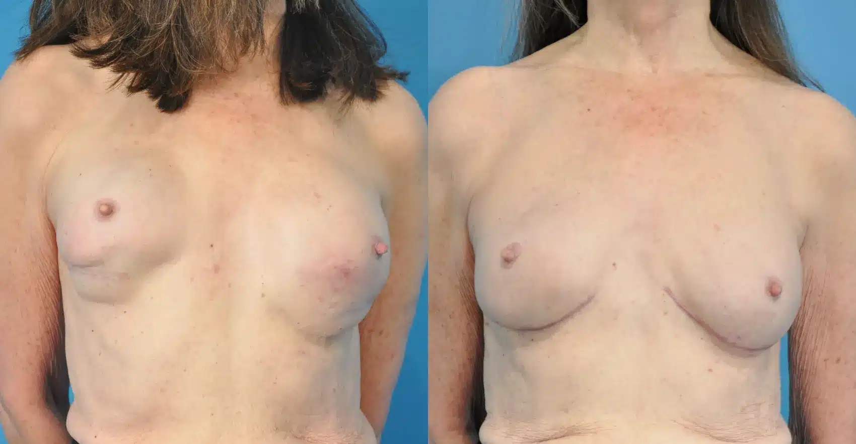 Before and After Image: Revision of Breast Reconstruction - front