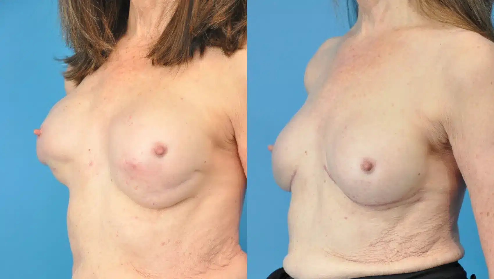 Before and After Image: Revision of Breast Reconstruction - left-front-oblique