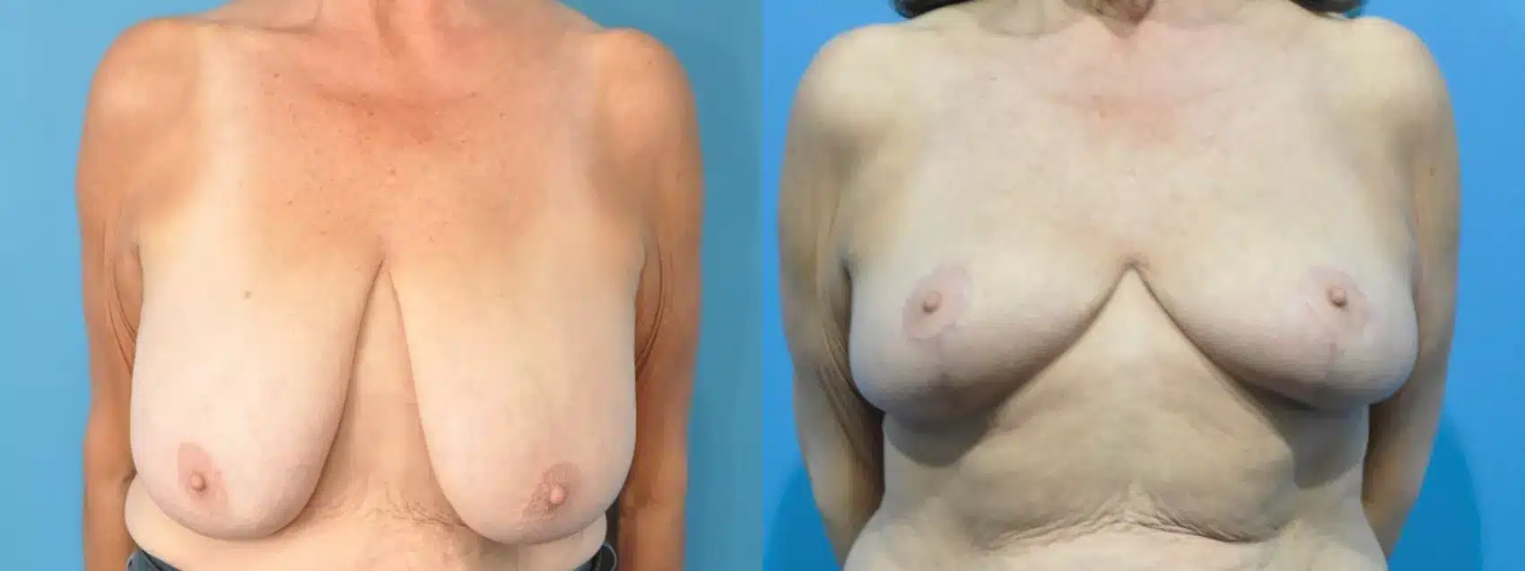 Before and After Image: Case #212 - front