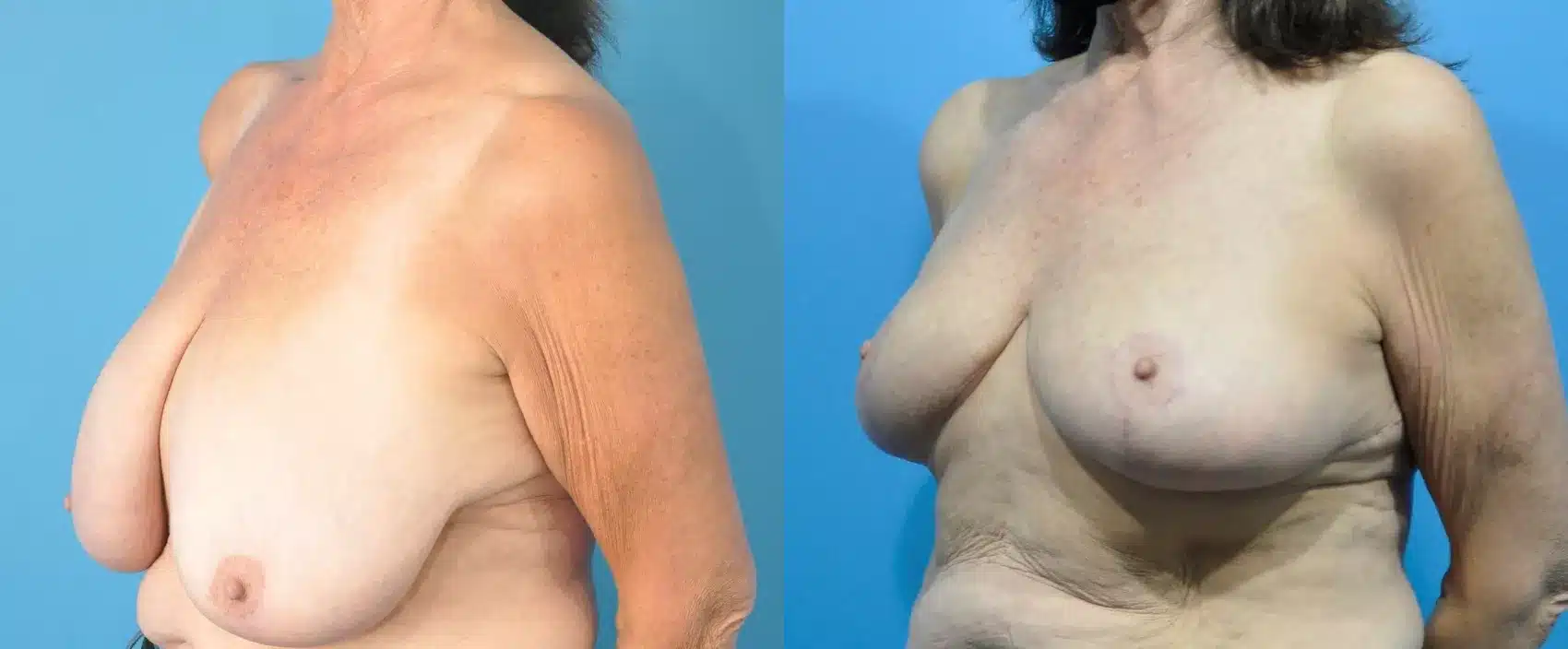 Before and After Image: Case #212 - left-front-oblique