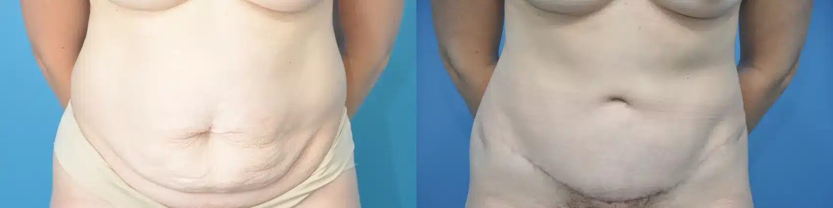 Before and After Image: Case #217 - front