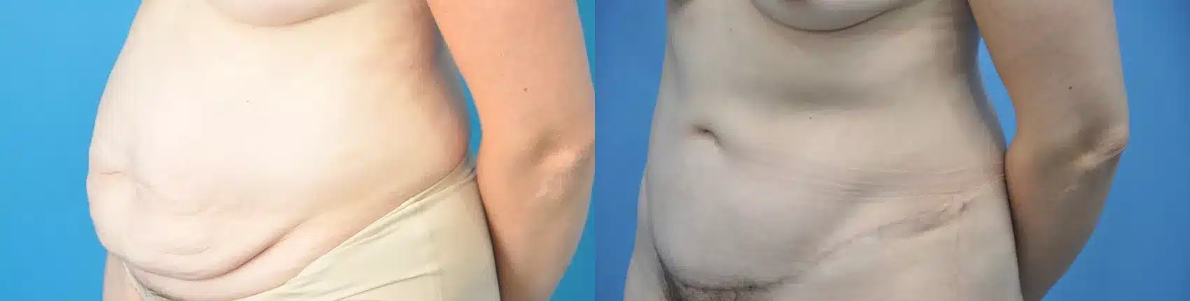 Before and After Image: Case #217 - left-front-oblique