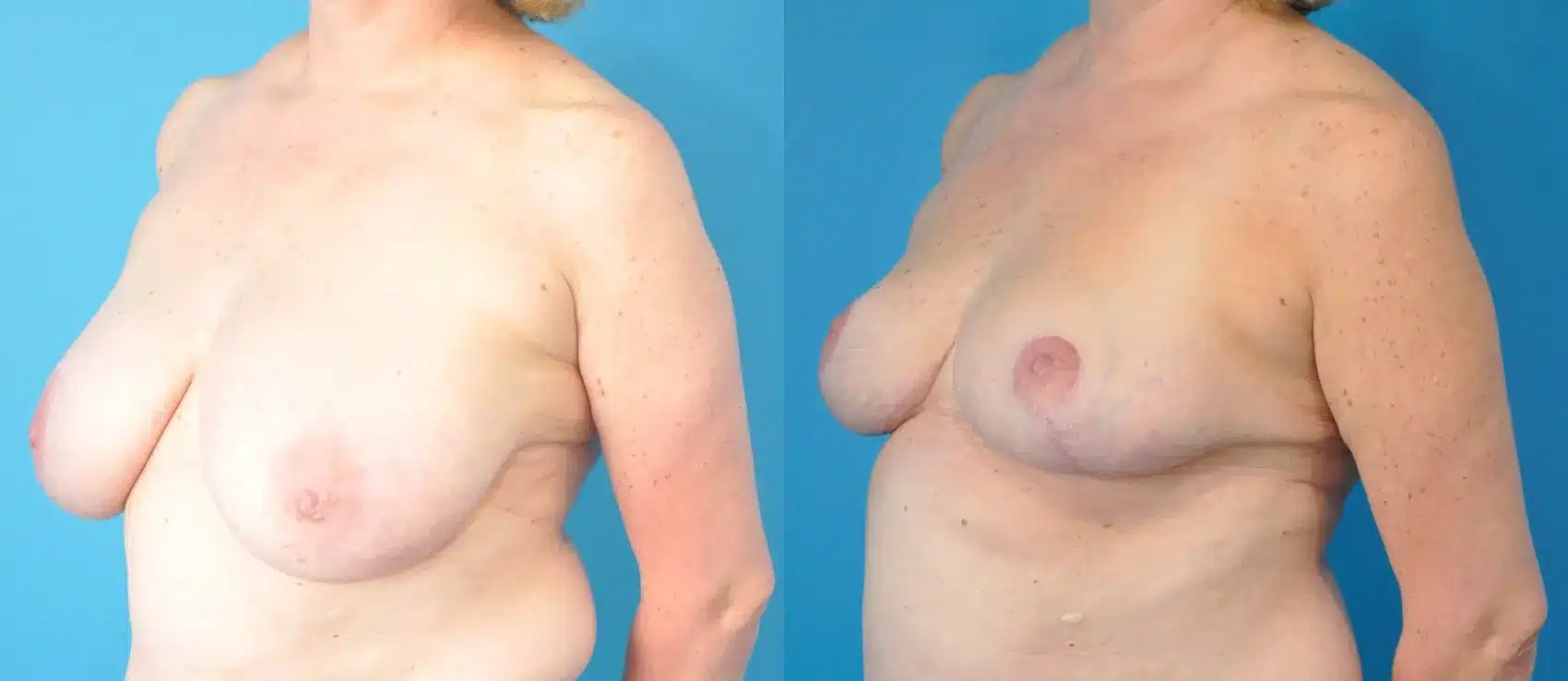 Before and After Image: Breast Reduction and Lift - left-front-oblique