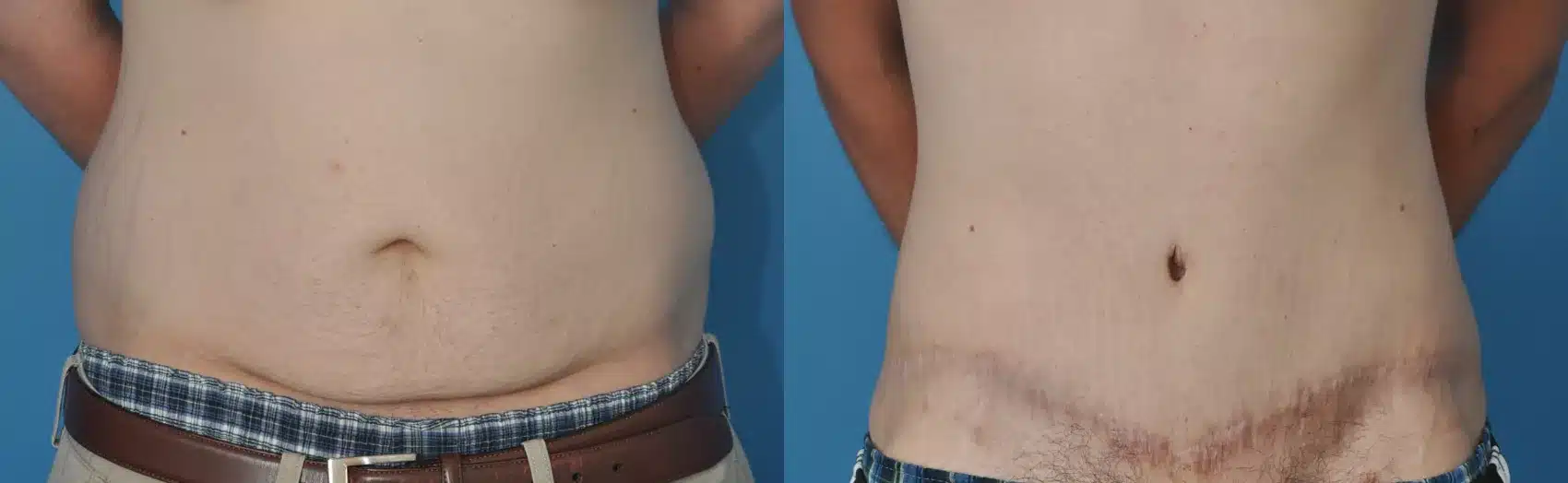 Before and After Image: Case #22 - front