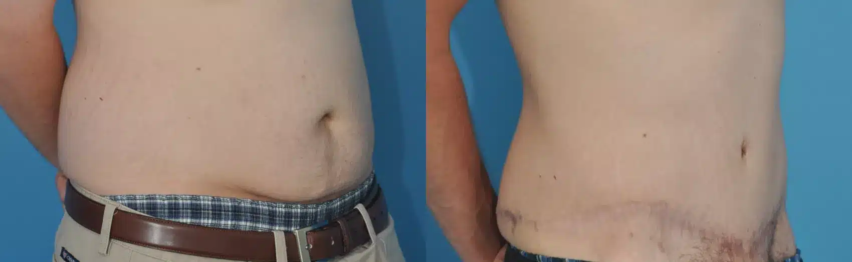 Before and After Image: Case #22 - right-front-oblique